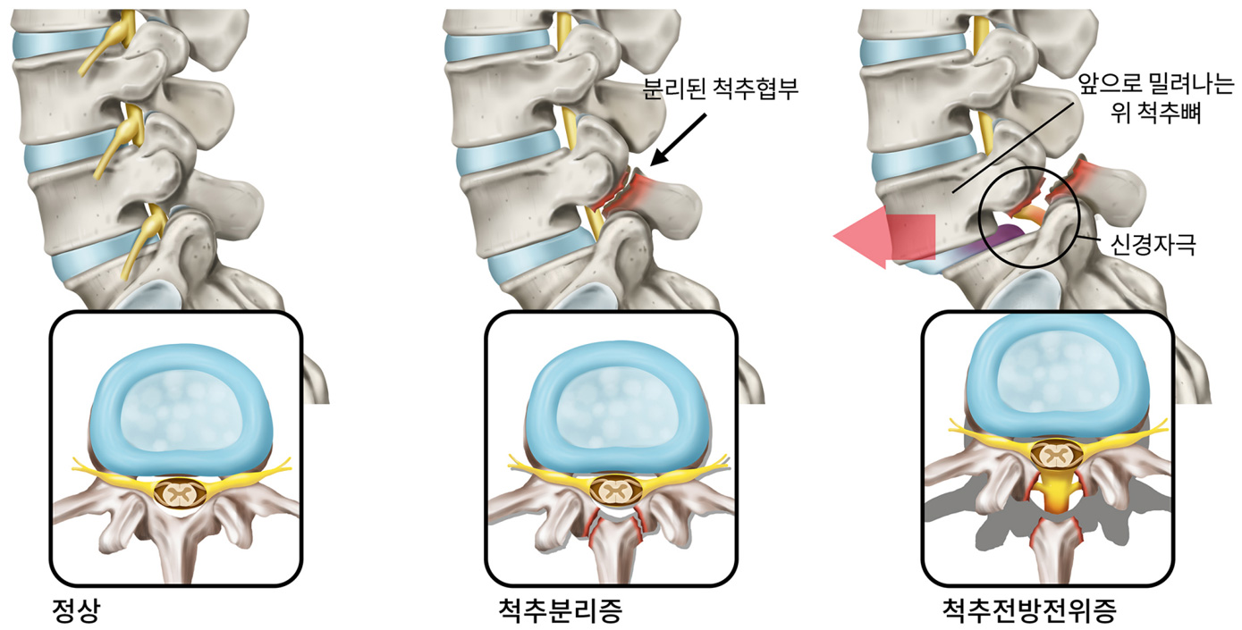 척추분리증과 척추전방전위증