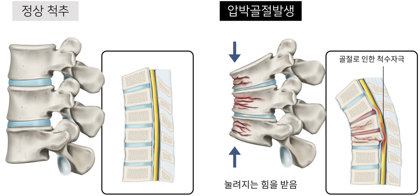 척추압박골절